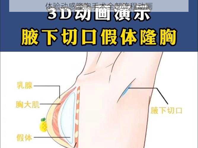 体验动感隆胸手术全部流程动画