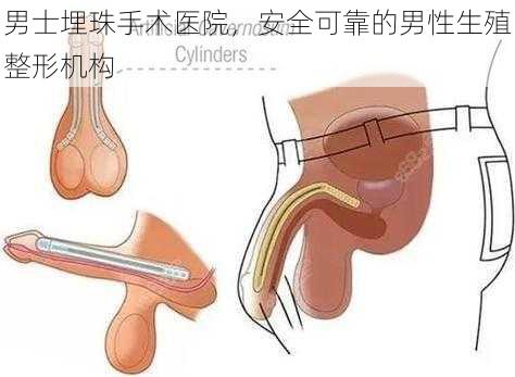 男士埋珠手术医院，安全可靠的男性生殖整形机构